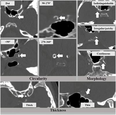 Intracranial Arterial Calcification and Intracranial Atherosclerosis: Close but Different